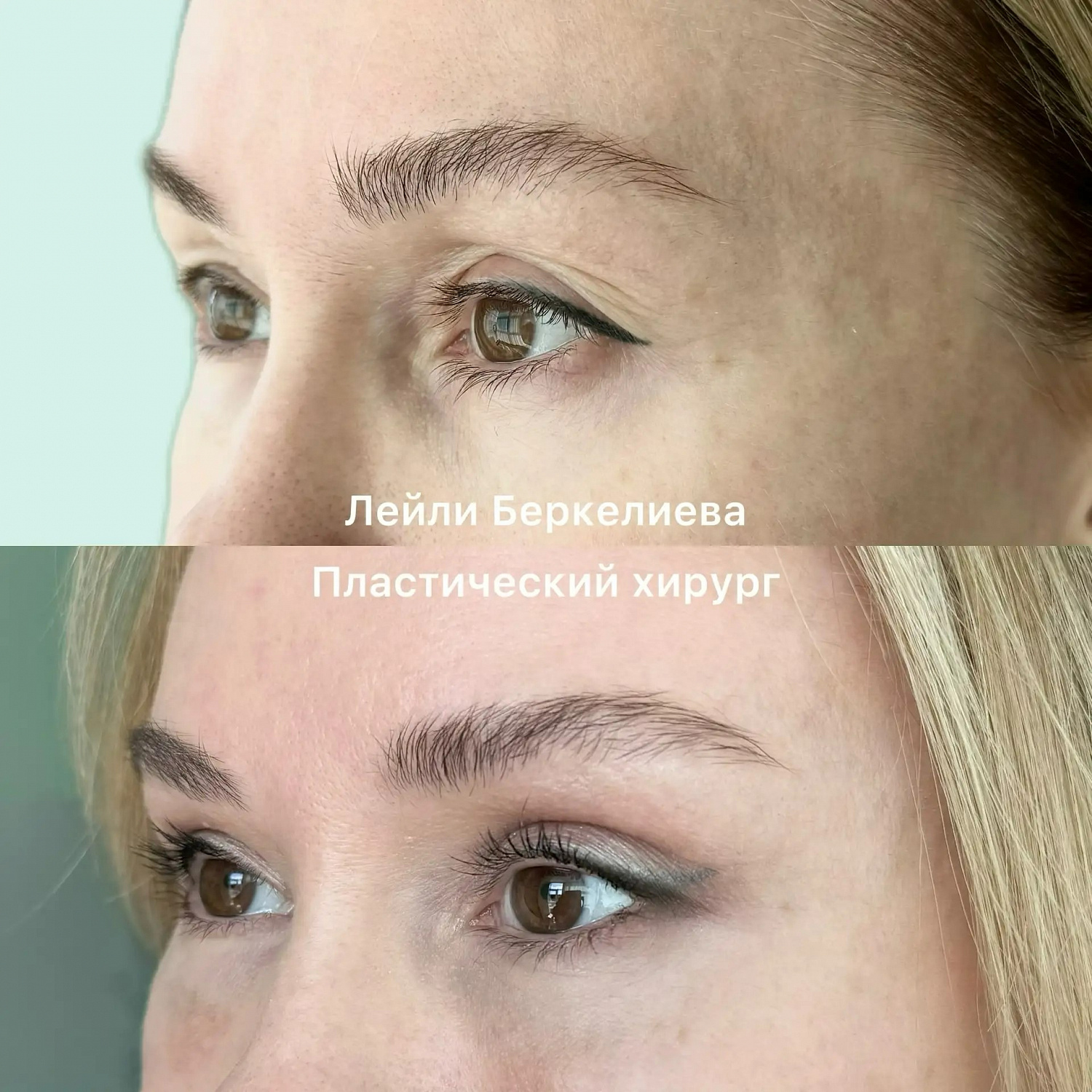 Блефаропластика